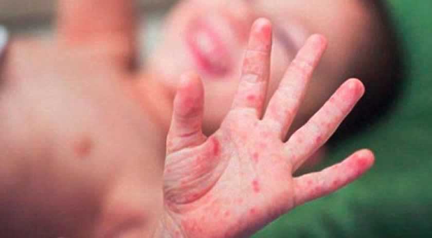 Chapecó enfrenta surto de doença 'mão-pé-boca' em oito escolas