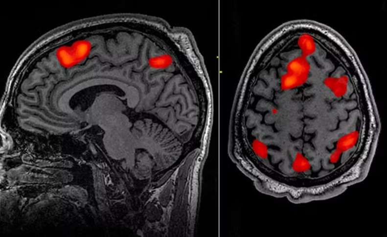 Estudo clínico registra primeiro tratamento bem-sucedido para a doença de Huntington
