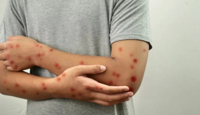 SC não registra casos de mpox em 2025, mas mantém vigilância ativa