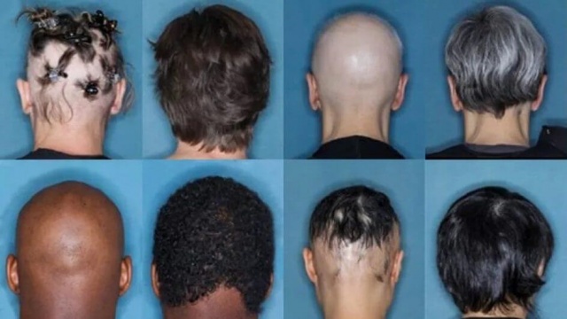 Anvisa aprova novo medicamento para tratar queda de cabelo