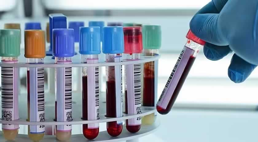Exame de sangue que rastreia Alzheimer pode virar real, diz estudo