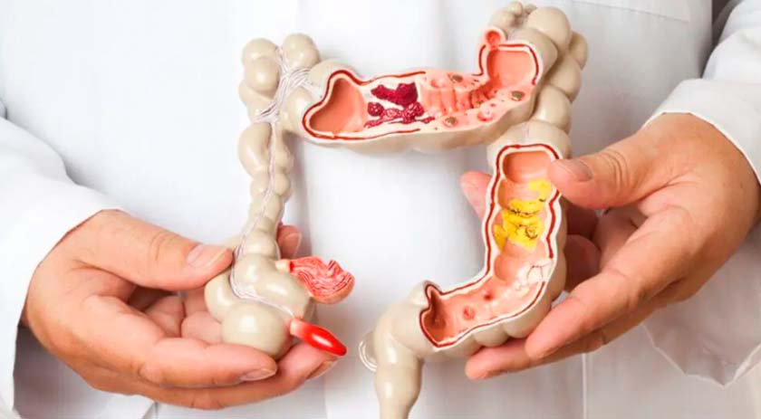 Mortes por câncer colorretal devem triplicar no Brasil até 2030