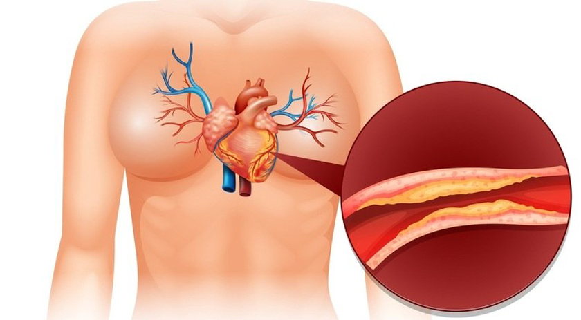 Infarto e derrame: conheça os riscos do colesterol alto para a saúde