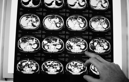 Anvisa aprova novo medicamento para tratar câncer colorretal metastático