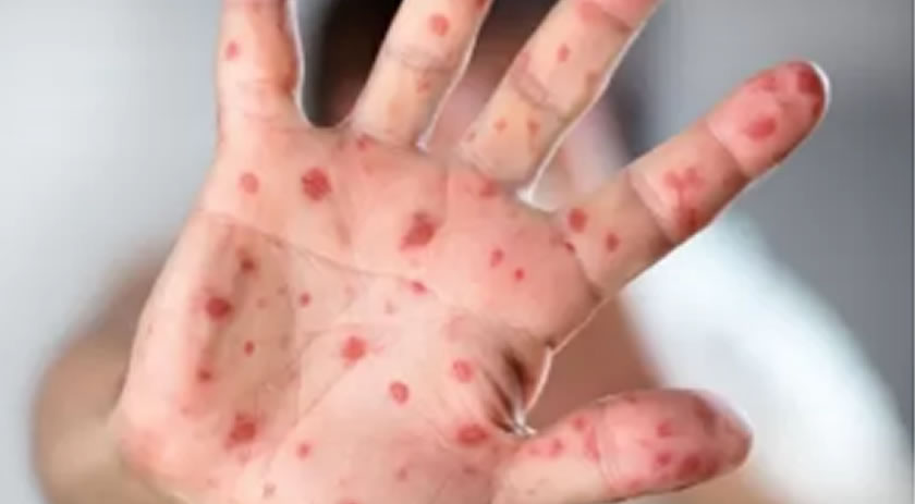 Com recorde negativo de vacinação, avanço do sarampo acende alerta para SC